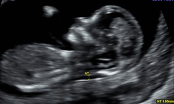 Pregnancy ultrasound scans at Bourn Hall Clinic